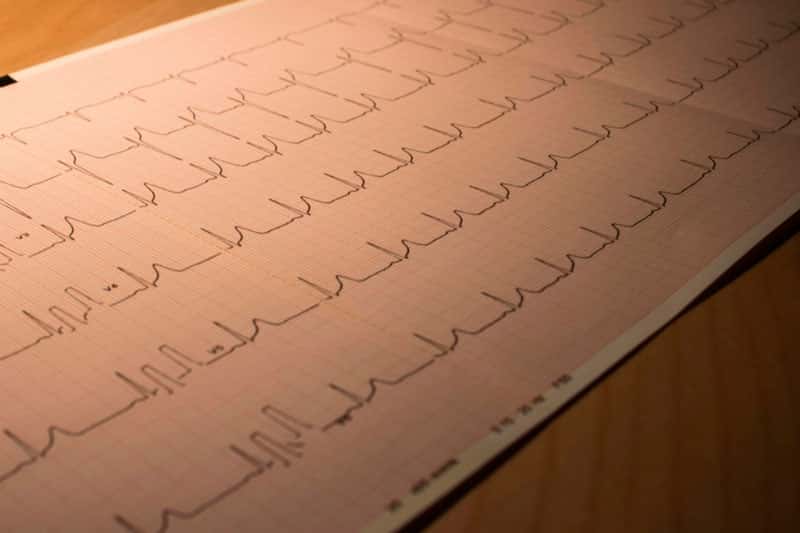 Ученые из Британии научились определять риск смерти от сердечно-сосудистых заболеваний