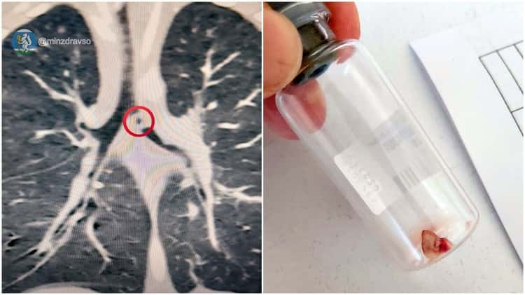 Чудо: свердловские врачи вытащили годовалого малыша из лап смерти после кусочка глины