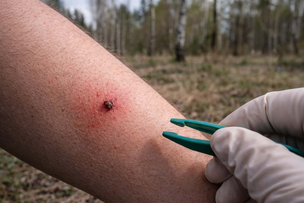 В Нижнем Тагиле зафиксировали первый укус клеща в 2026 году