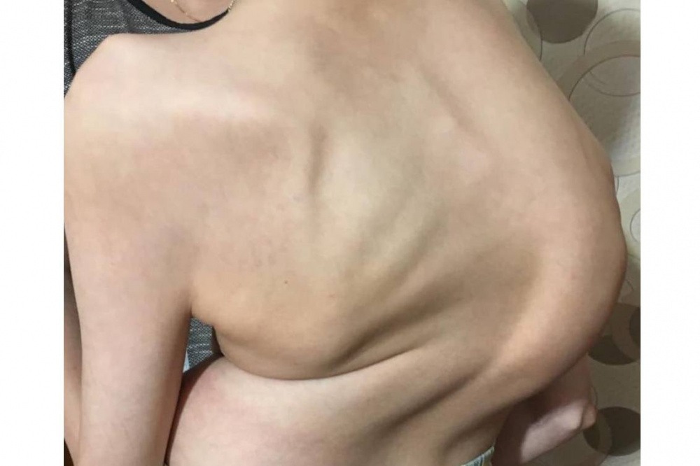 В Свердловской области врачи провели сложную операцию по коррекции сколиоза 19-летнему пациенту  | На Урале медики провели сложную операцию молодому пациенту, страдающему от сколиоза 