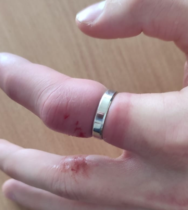 Спасатели в Нижнем Тагиле успешно сняли с опухшего пальца мужчины застрявшее кольцо | Спасатели в Нижнем Тагиле успешно сняли с опухшего пальца мужчины застрявшее кольцо
