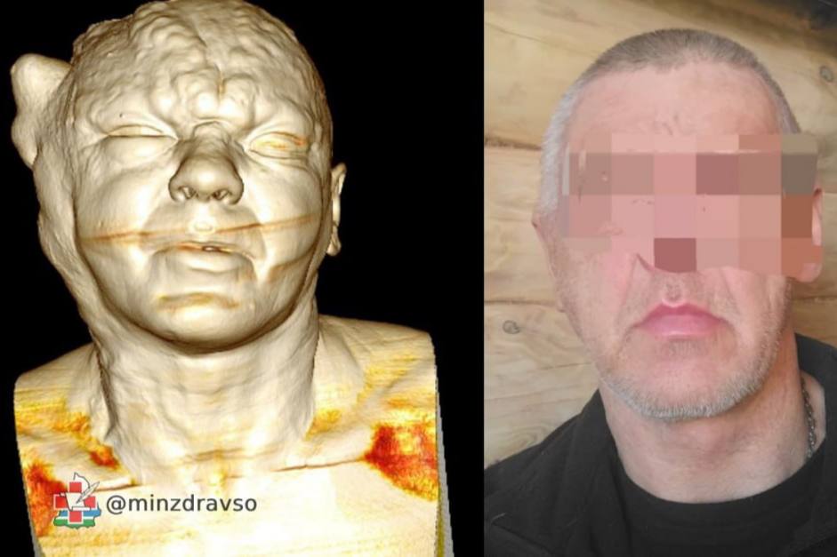 Свердловские врачи помогли трем местным жителям избавиться от дефектов внешности | На Урале медики помогли пациентам избавиться от объемных новообразований на голове