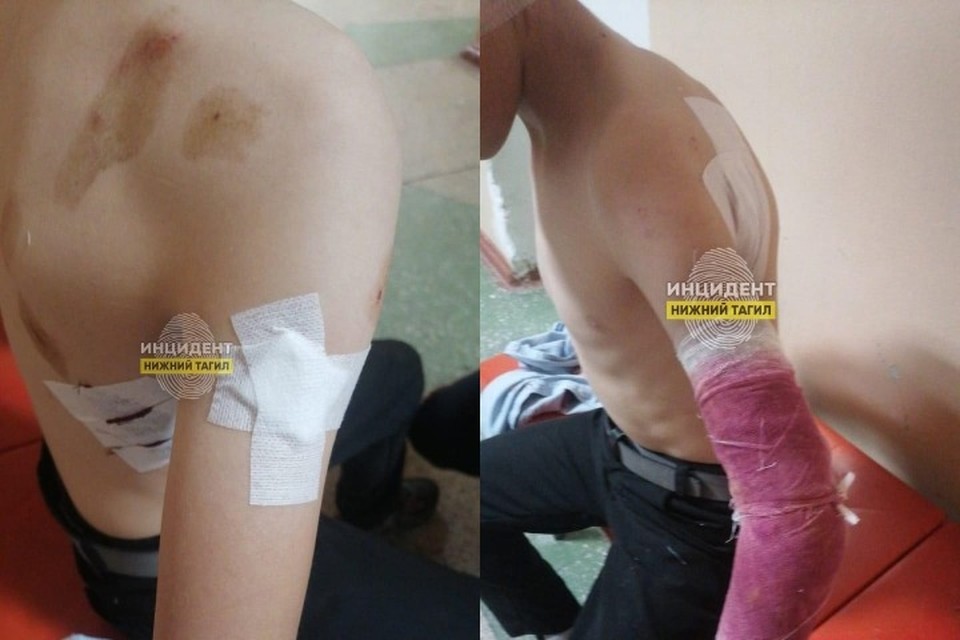 У ребенка, которого покусала собака в Нижнем Тагиле, может развиться эпилепсия