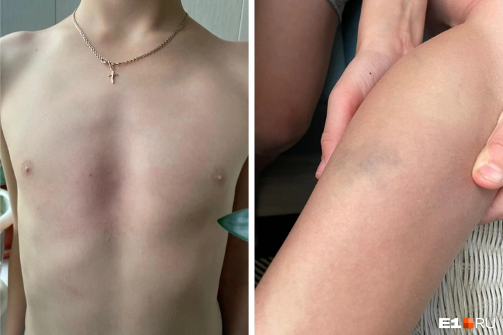 Драка из-за девочки в Екатеринбурге: одноклассники избили мальчика, подозрение на перелом позвоночника