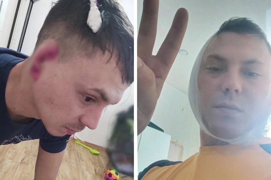 На Урале мужчине откусили ухо в пьяной драке