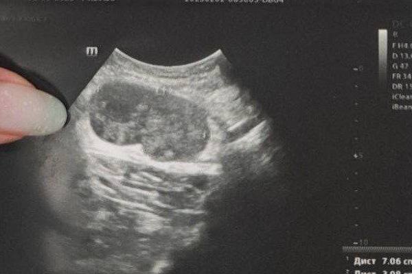 Шарик под мышкой оказался серьезным заболеванием: уральские медики вовремя поставили диагноз | На Урале у пациента обнаружили крайне редкий случай метастаза без первичной опухоли Шарик под мышкой оказался серьезным заболеванием: уральские медики вовремя поставили диагноз | На Урале у пациента обнаружили крайне редкий случай метастаза без первичной опухоли